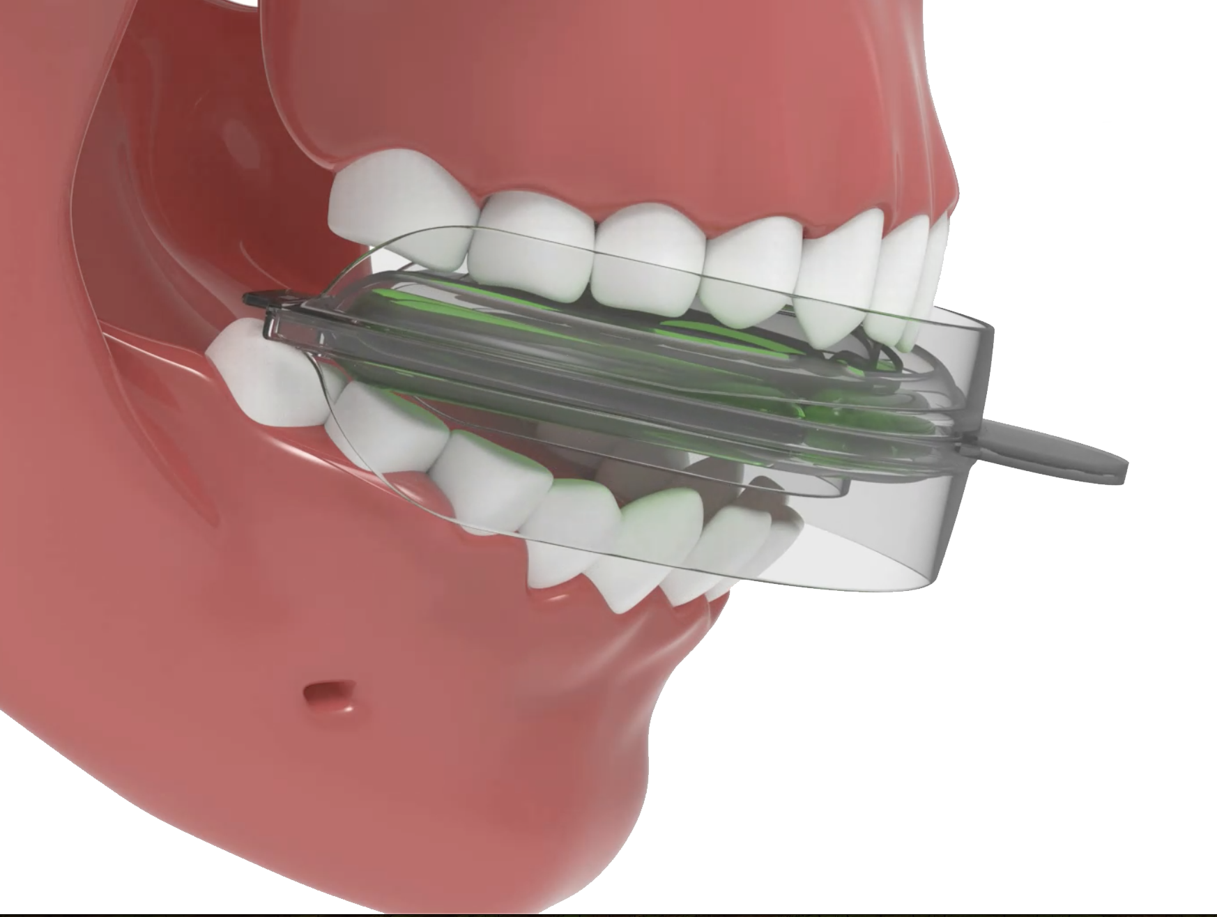 Insert OraTray and bite down