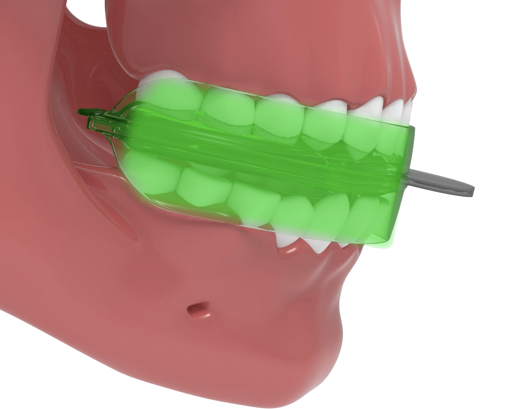 Complete fluoride coverage